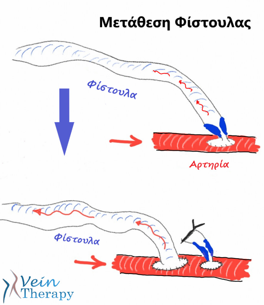 Τι γίνεται όταν σταματά να λειτουργεί η φίστουλα; 1